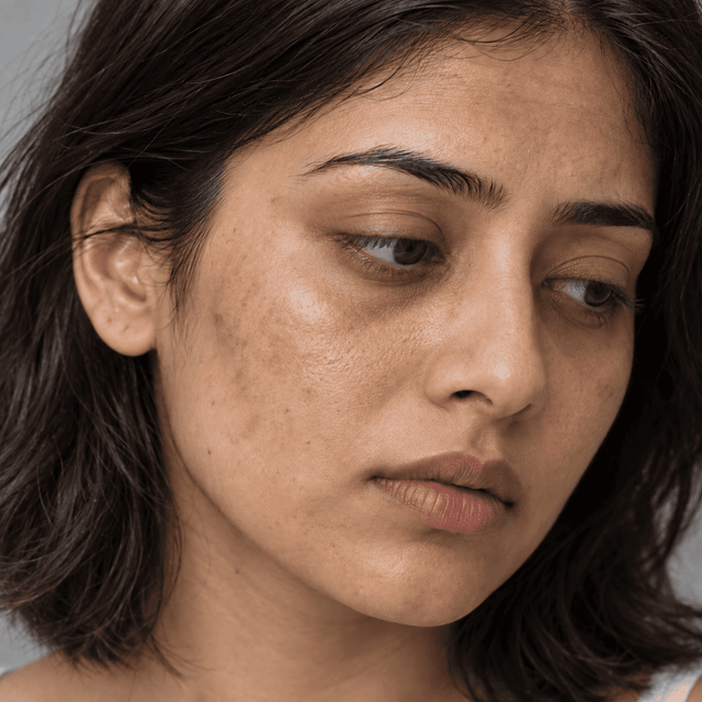 Uneven Skin Tone