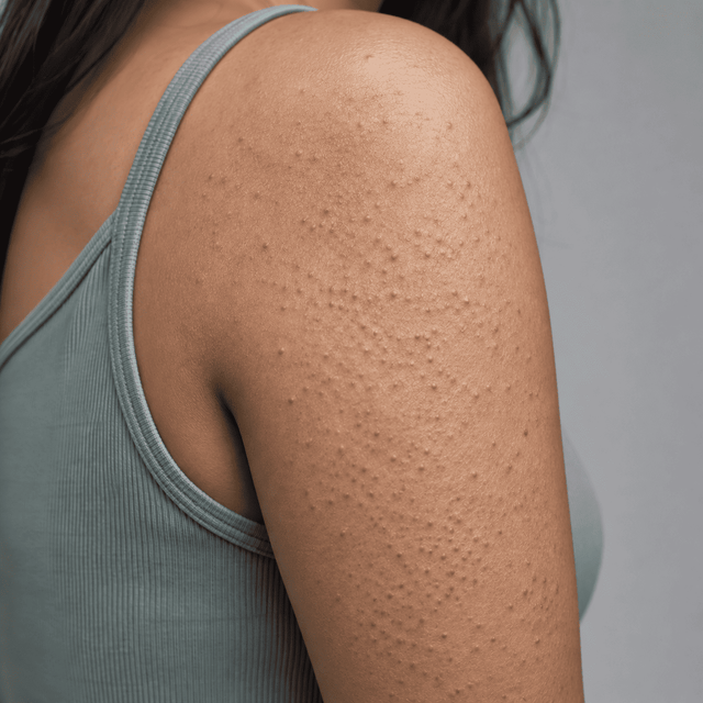 Keratosis pilaris
