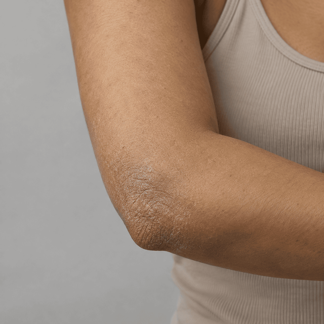 Rough, dry patches