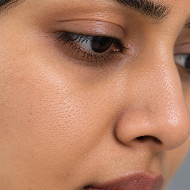 Clogged Pores